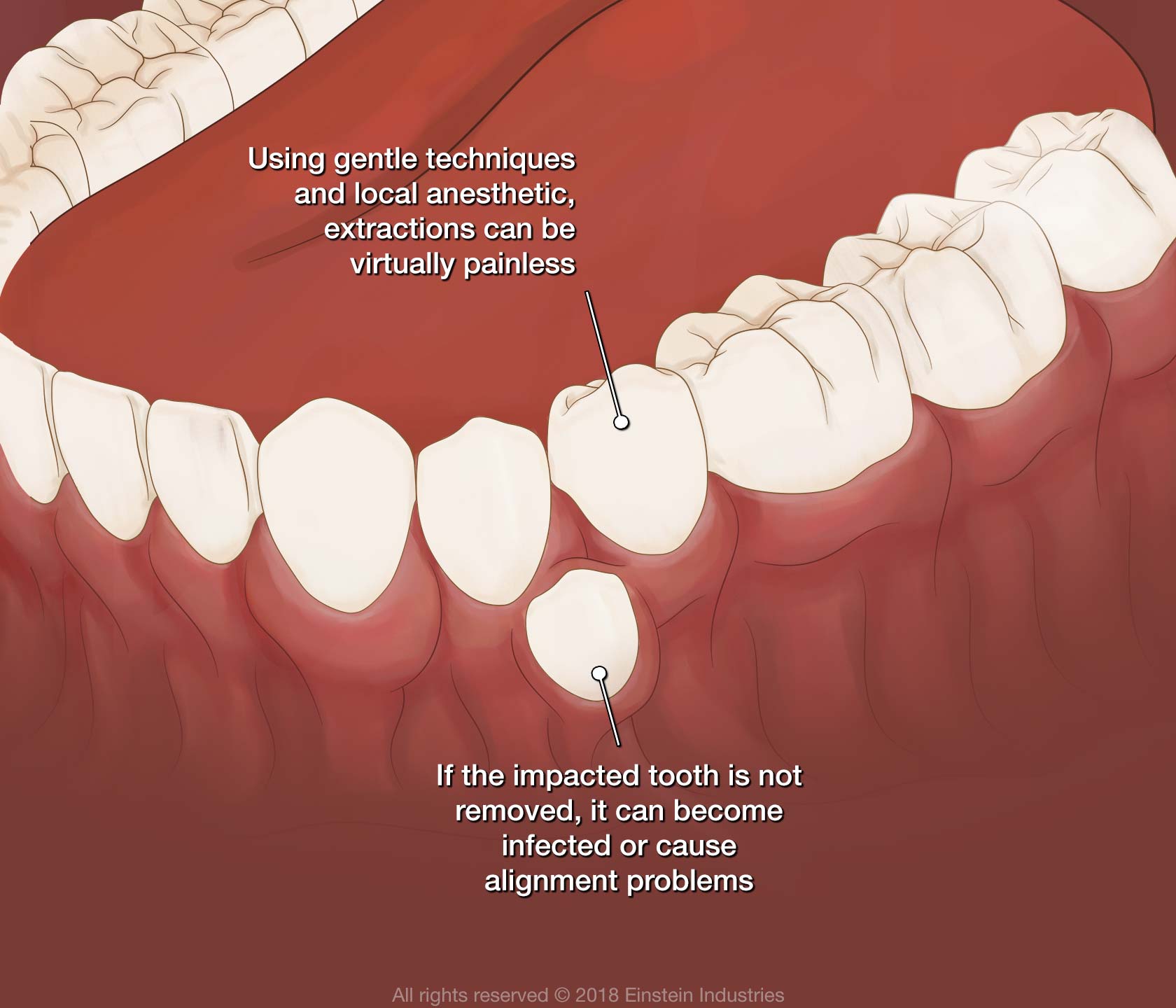 illustration of an impacted tooth that needs extraction