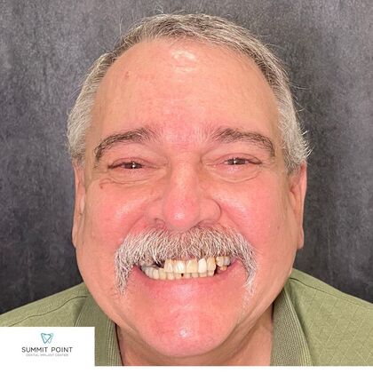 Dr. Sasan Khodabakhsh's patient with missing teeth